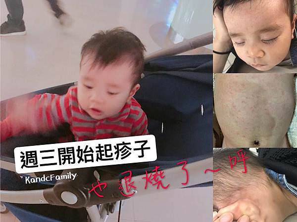 玫瑰疹4.jpg 玫瑰疹4.jpg