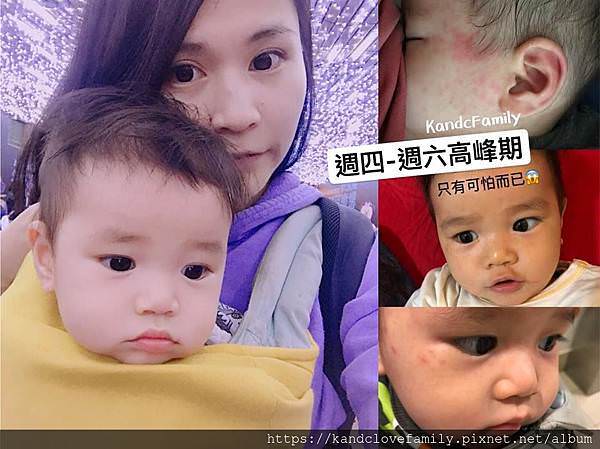 玫瑰疹.jpg 玫瑰疹.jpg